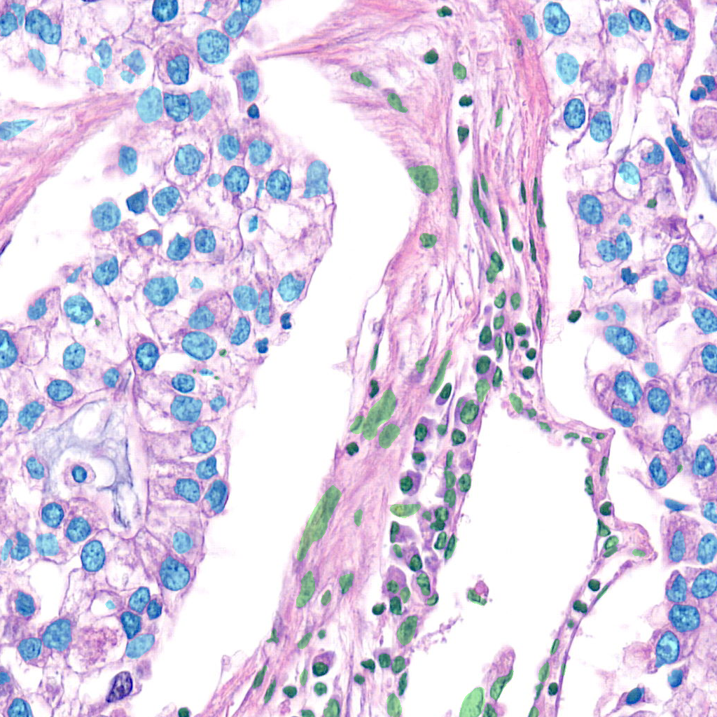 lung example