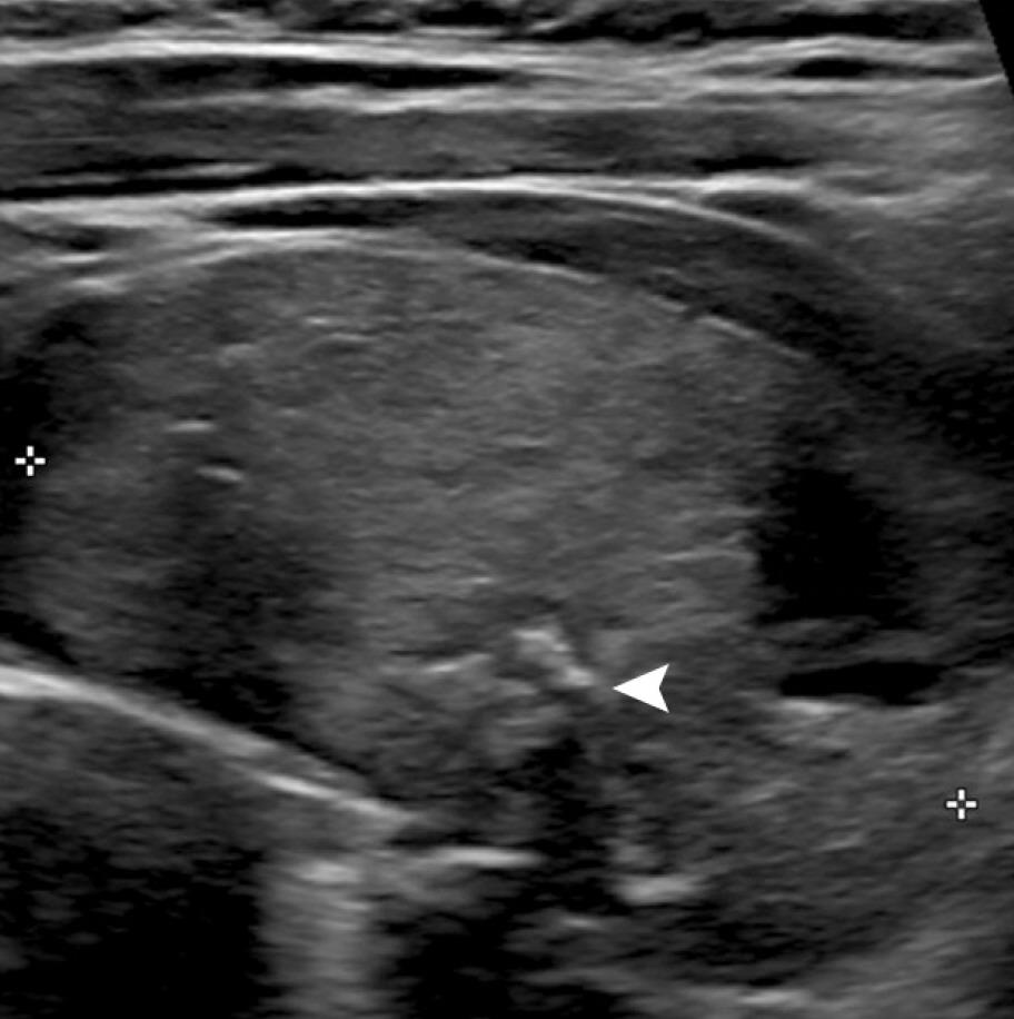 Pic3_Macrocalcifications.jpeg