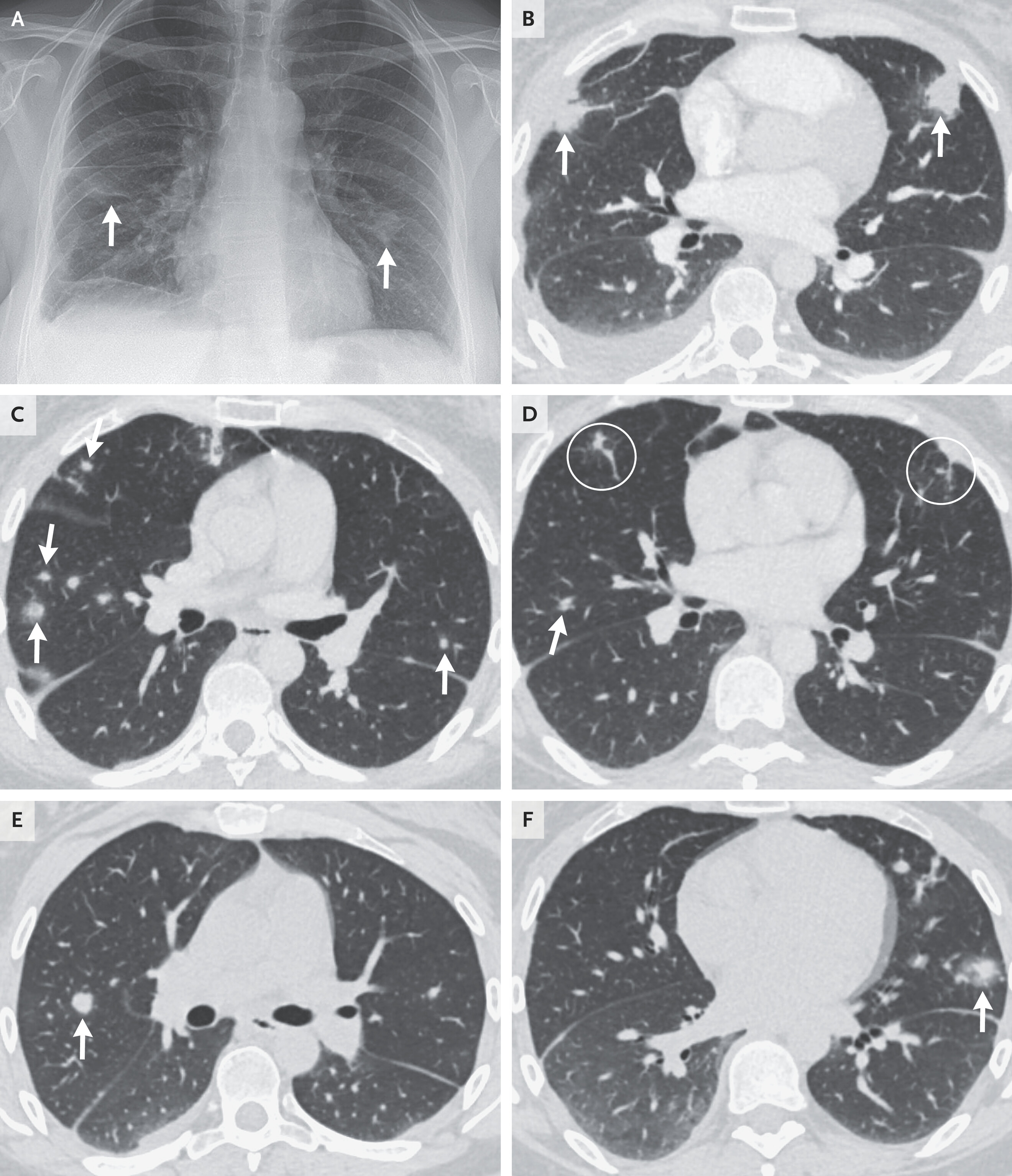 Lung cancer woman 38 years old