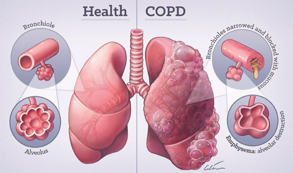 COPD.png